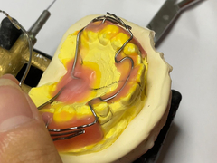 أداة تقويم الأسنان المصنوعة خصيصا مع الاحتفاظ الجيد والخصائص القابلة للتعديل