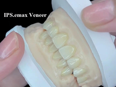 IPS.emax Veneer الحل الجمالي المتميز لتغييرات ابتسامة مذهلة