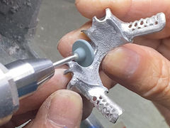 أسنان جزئية صب