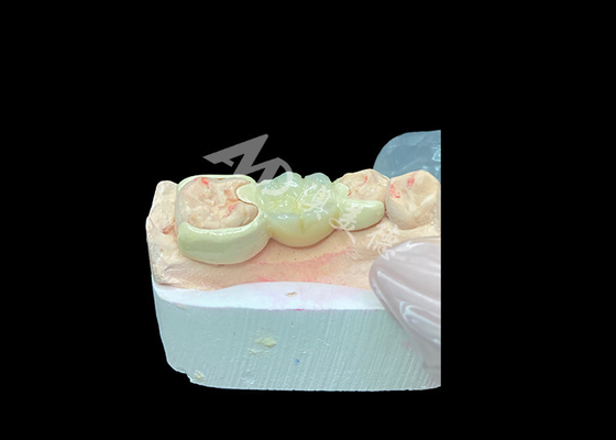 شراء تاج الزركونيا مع جسر HPP المرتبط لتحسين جمالية الابتسامة والتوافق البيولوجي online manufacture
