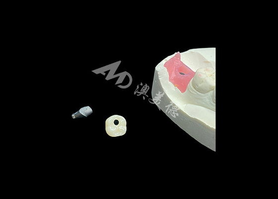 شراء تاج زرع أسنان طويل الأمد يحدث ثورة في إجراءات طب الأسنان online manufacture
