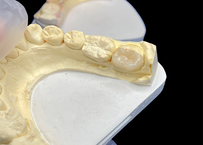 IPS e.max الألواح الخزفية المزروعة والملصقة لترميم الأذنين الجمالية الطبيعية والمتانة العالية لتحقيق نتائج طويلة الأمد