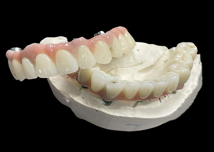 أساس التيتانيوم الأسنان الاصطناعية الثابتة المدعومة مع الجسر التاج السيراميكي لاستبدال الأسنان المفقودة
