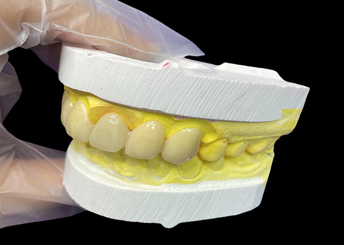 التجميل فيتا الظل الكلاسيكي التاج السيراميكي والجسور مع المناسبة الدقيقة المظهر الطبيعي وخيارات قابلة للتخصيص
