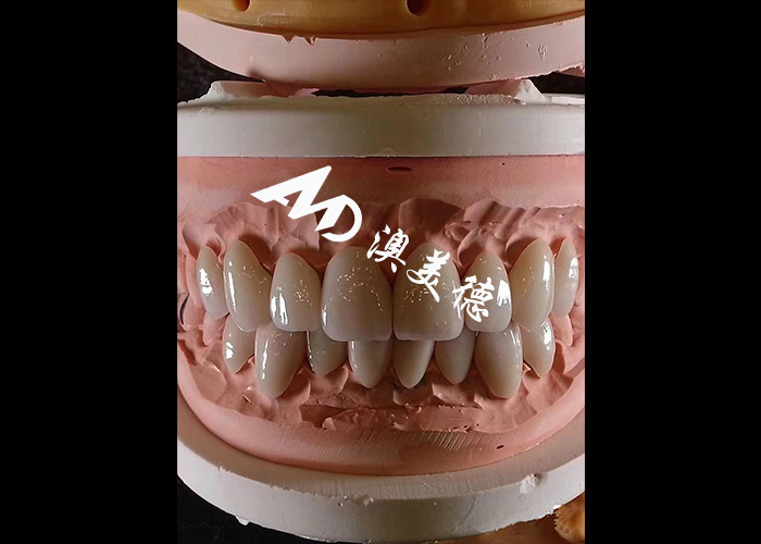 طب الأسنان التجميلي EMAX القشرة الأسنانية 0.3-0.5mm سميكة لاستعادة الجمال