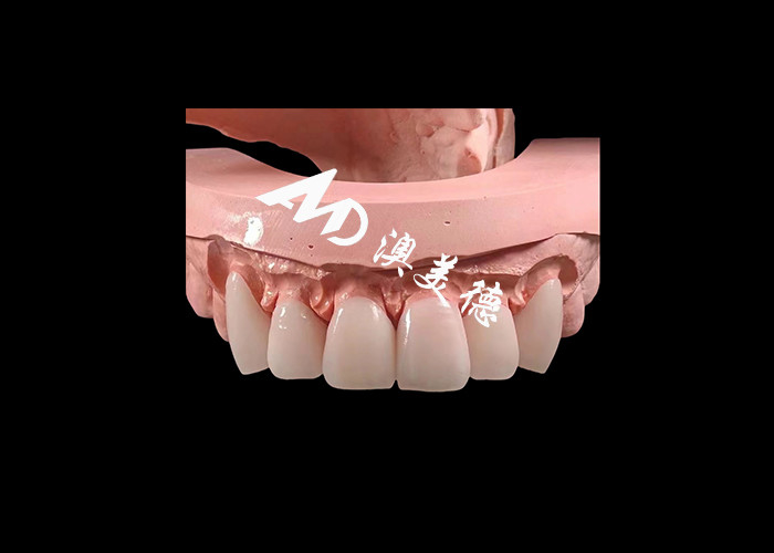 طب الأسنان التجميلي EMAX القشرة الأسنانية 0.3-0.5mm سميكة لاستعادة الجمال