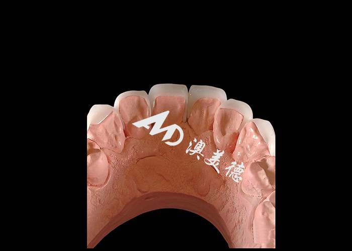 طب الأسنان التجميلي EMAX القشرة الأسنانية 0.3-0.5mm سميكة لاستعادة الجمال