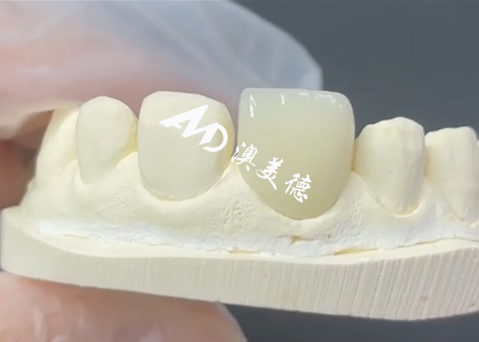 القشرة EMAX القابلة للاستمرار والجمالية الحل المثالي لاستعادة البورسلين