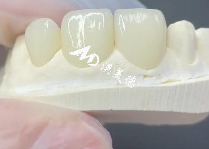 القشرة EMAX القابلة للاستمرار والجمالية الحل المثالي لاستعادة البورسلين