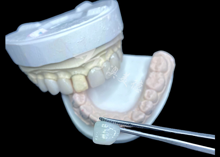 IPS e.max الشاشات في ظل BL2 تحقق جماليات طبيعية مذهلة مع 8 وحدات مصنوعة بشكل مثالي