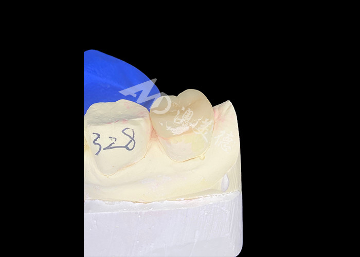 IPS E.max القالبات السيراميكية القالبات المختلطة بشكل سلس تبدو طبيعية ومتينة مع أسنانك