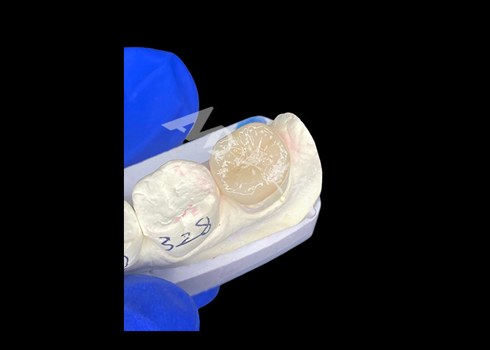 IPS E.max القالبات السيراميكية القالبات المختلطة بشكل سلس تبدو طبيعية ومتينة مع أسنانك