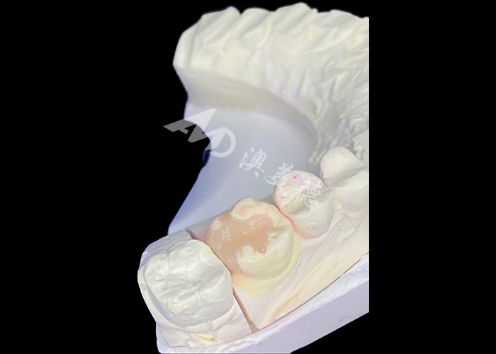 IPS e.max الألواح السيرامية المزروعة والألواح المزروعة لإعادة التجميل اللحمي مع نتائج جمالية طبيعية ودائمة