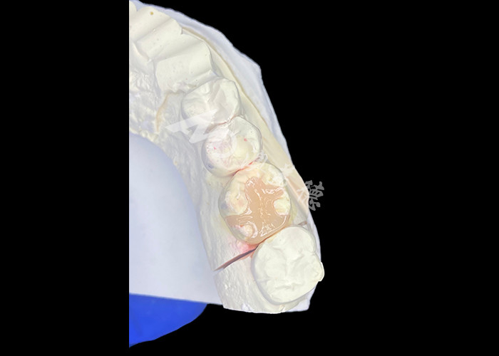 IPS e.max الألواح السيرامية المزروعة والألواح المزروعة لإعادة التجميل اللحمي مع نتائج جمالية طبيعية ودائمة